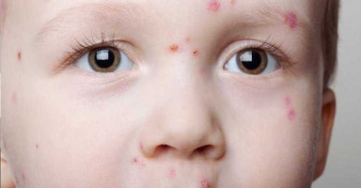 Odra choroba wymagająca szczepionki