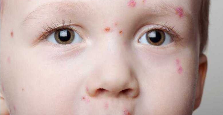 Odra choroba wymagająca szczepionki