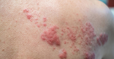 Chorujesz na odrę? Uważaj na powikłania!