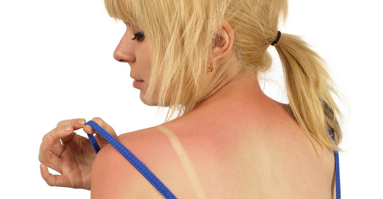 Gdy poparzy Cię słońce