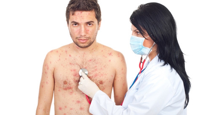 Dziecko z ospą wietrzną nie powinno wychodzić na dwór przynajmniej przez dwa tygodnie