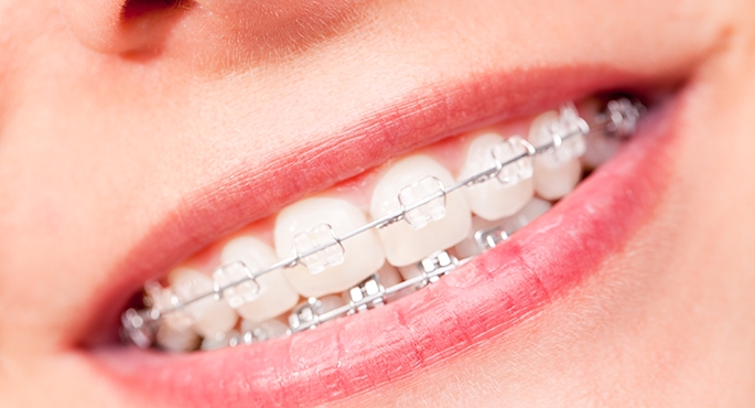 Blisko 80 proc. wad zgryzu ma charakter nabyty. Ale możesz je skorygować w każdym wieku