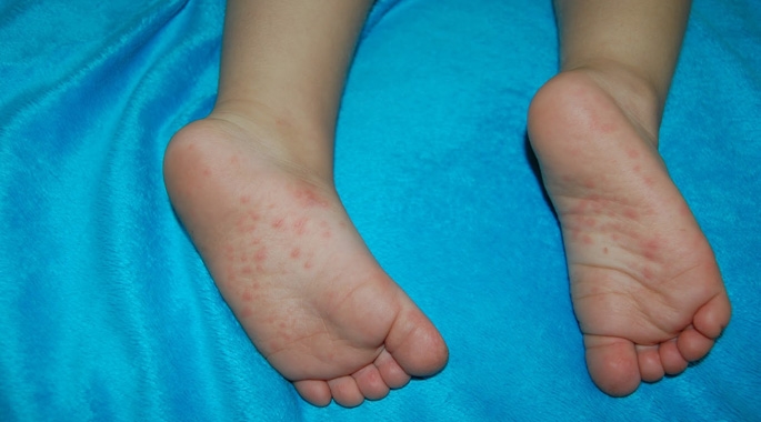 Bostonka może powodować powikłania, np. zapalenie mięśnia sercowego