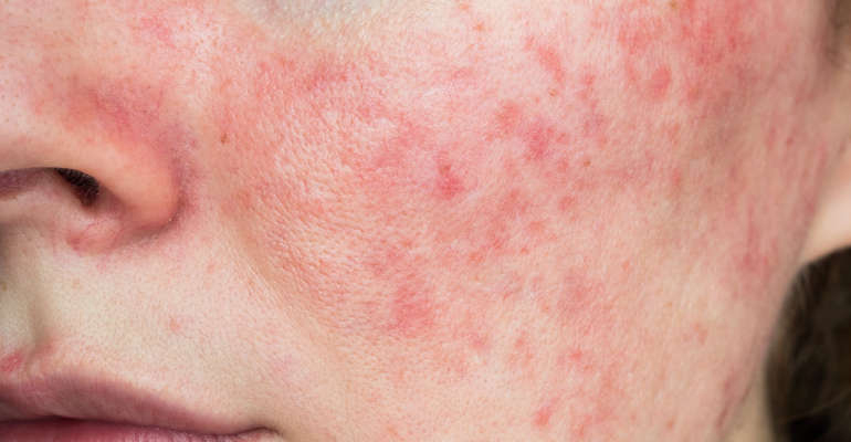 Trądzik różowaty do menopauzie