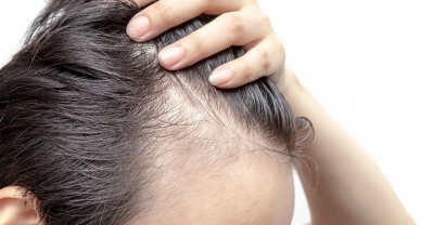 Dlaczego kobiety łysieją