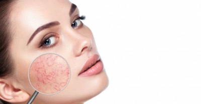 Witamina K. wzmocni cerę naczyniową