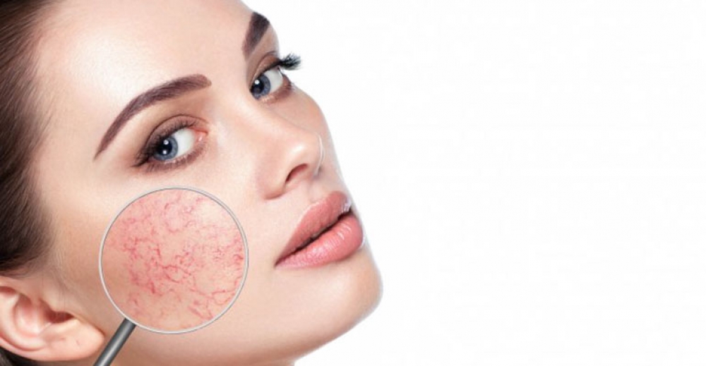 Witamina K. wzmocni cerę naczyniową