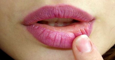 Opryszczka czyli osłabienie