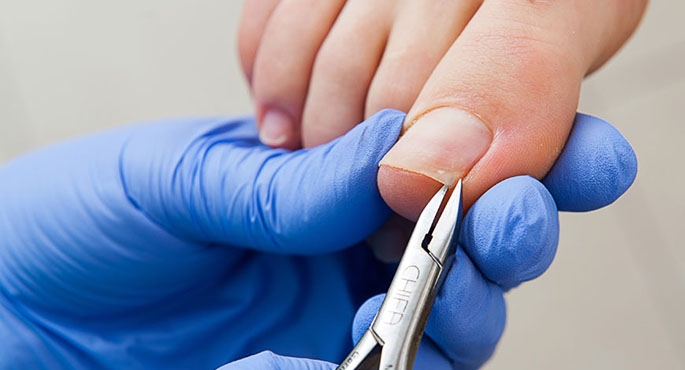 Paznokieć może wrastać po jednej albo po obu stronach palca równocześnie