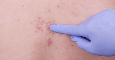 Półpasiec – wysypka, która boli!