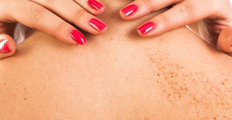 Dobrze traktowane znamię