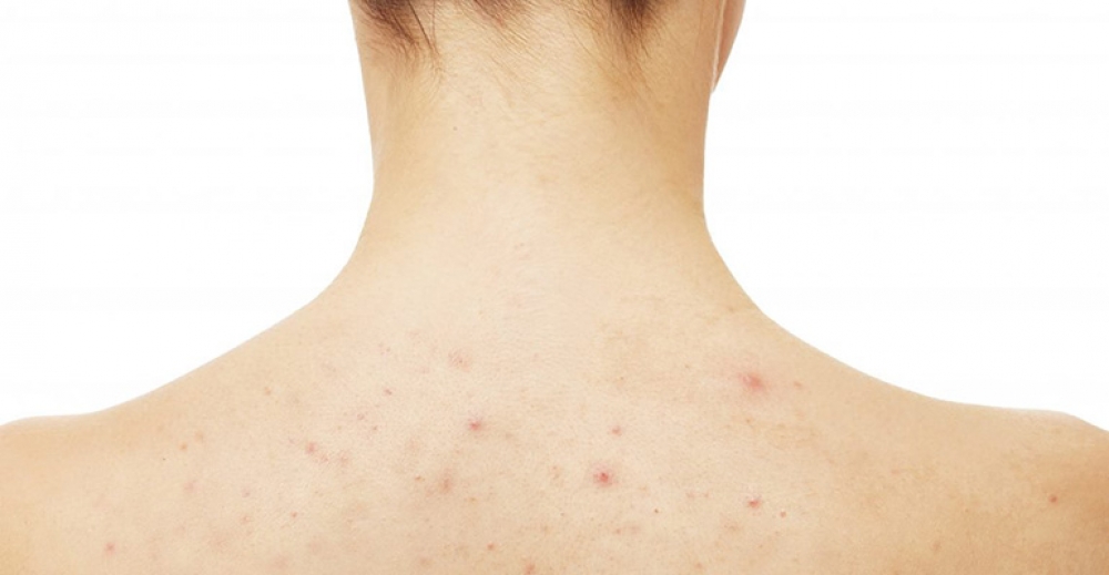 Trądzik na plecak – jak z nim walczyć?