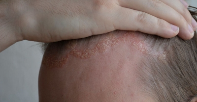 Zadbaj o skórę głowy z łuszczycą